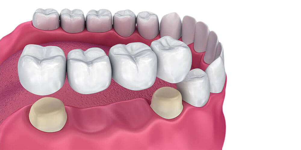 Dental Bridges Gatineau