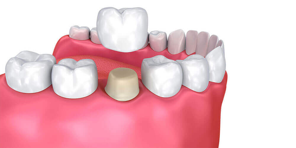 Dental Crowns Gatineau
