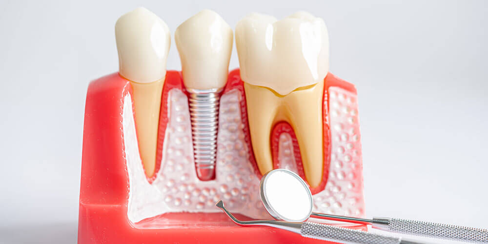 Dental Implants Gatineau