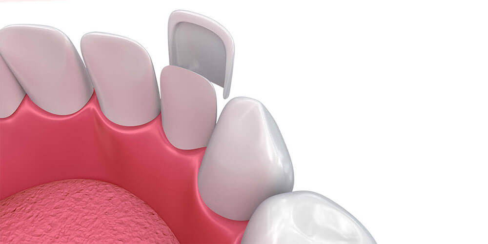 Dental Veneers Gatineau